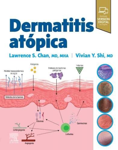Dermatitis Atópica
