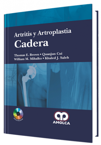 Artritis y Artroplastia Cadera